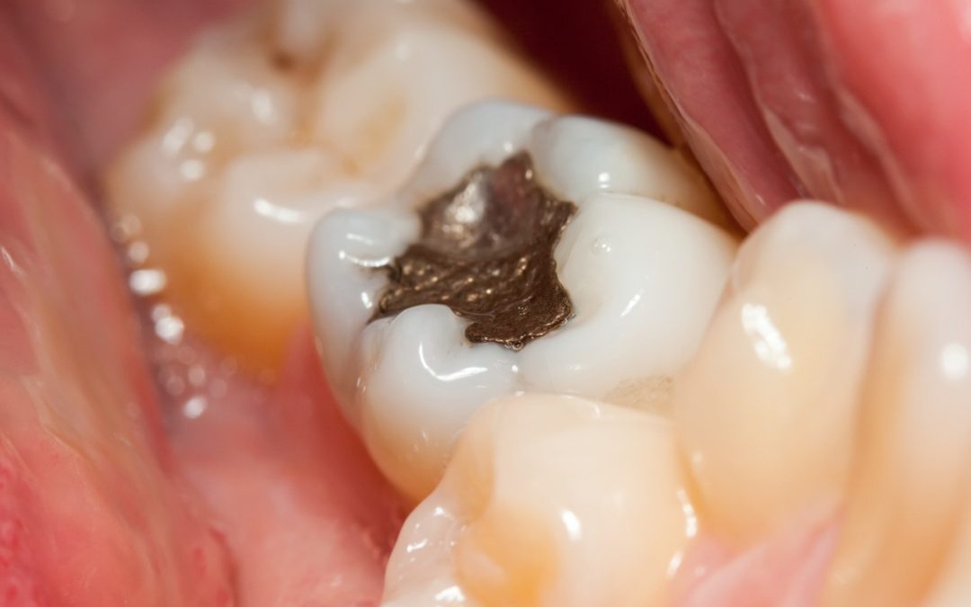 Alt text: An up-close image of a tooth depicting the appearance of silver amalgam dental fillings
